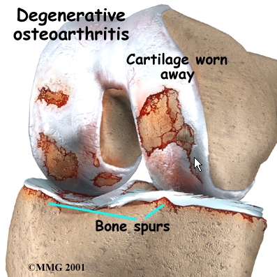 Steroid injections in osteoarthritis